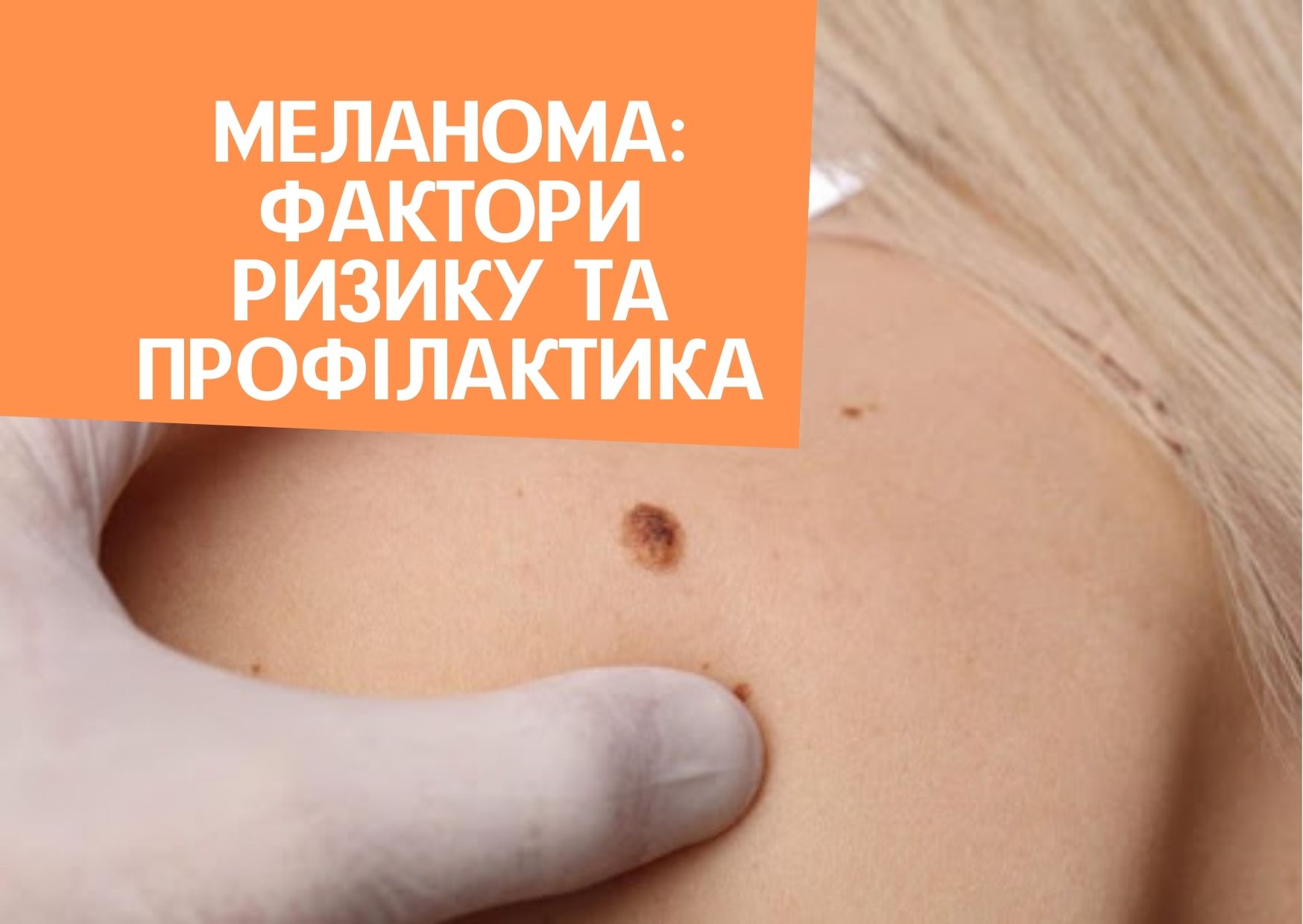 Меланома: фактори ризику та профілактика