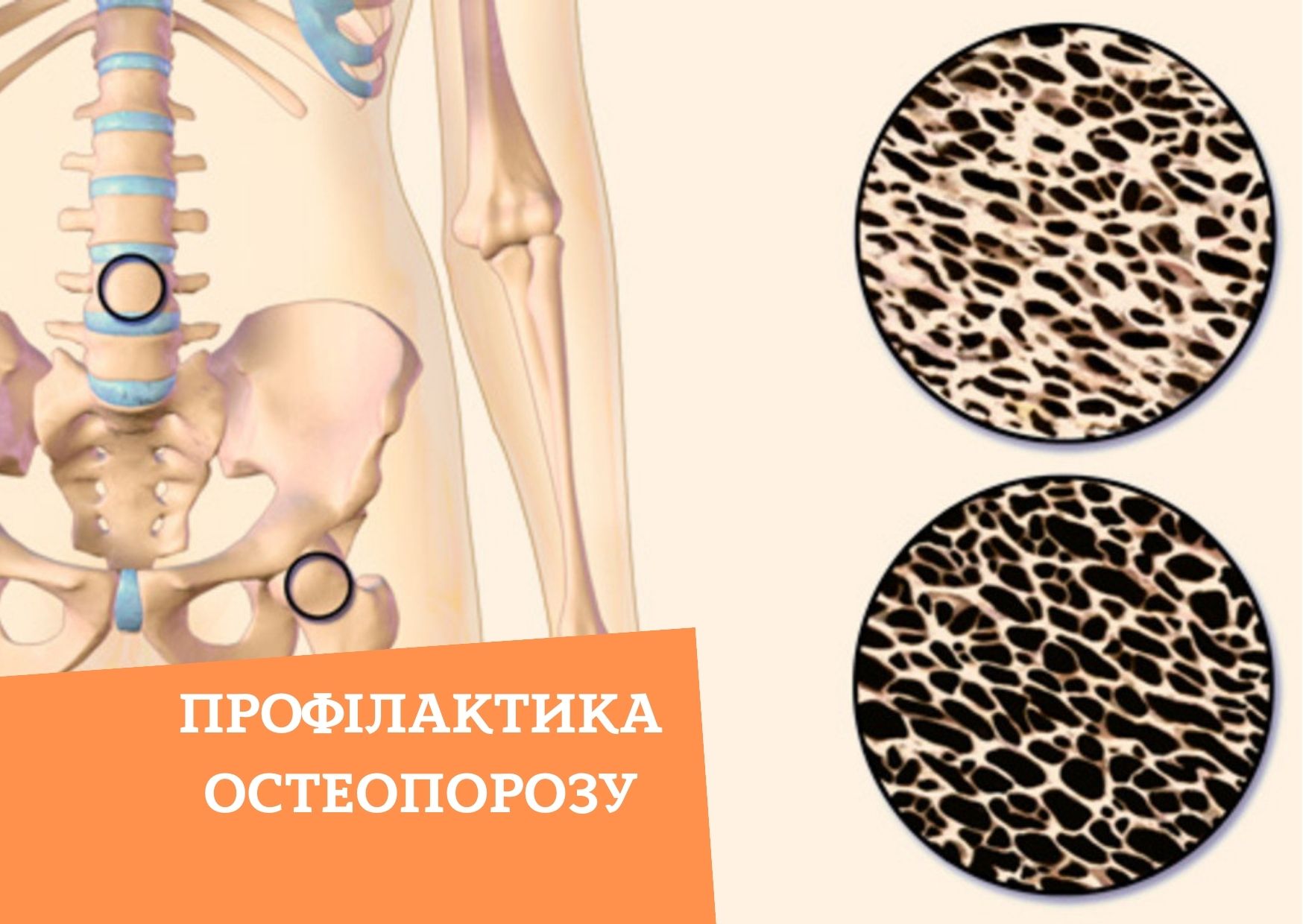 Профілактика остеопорозу