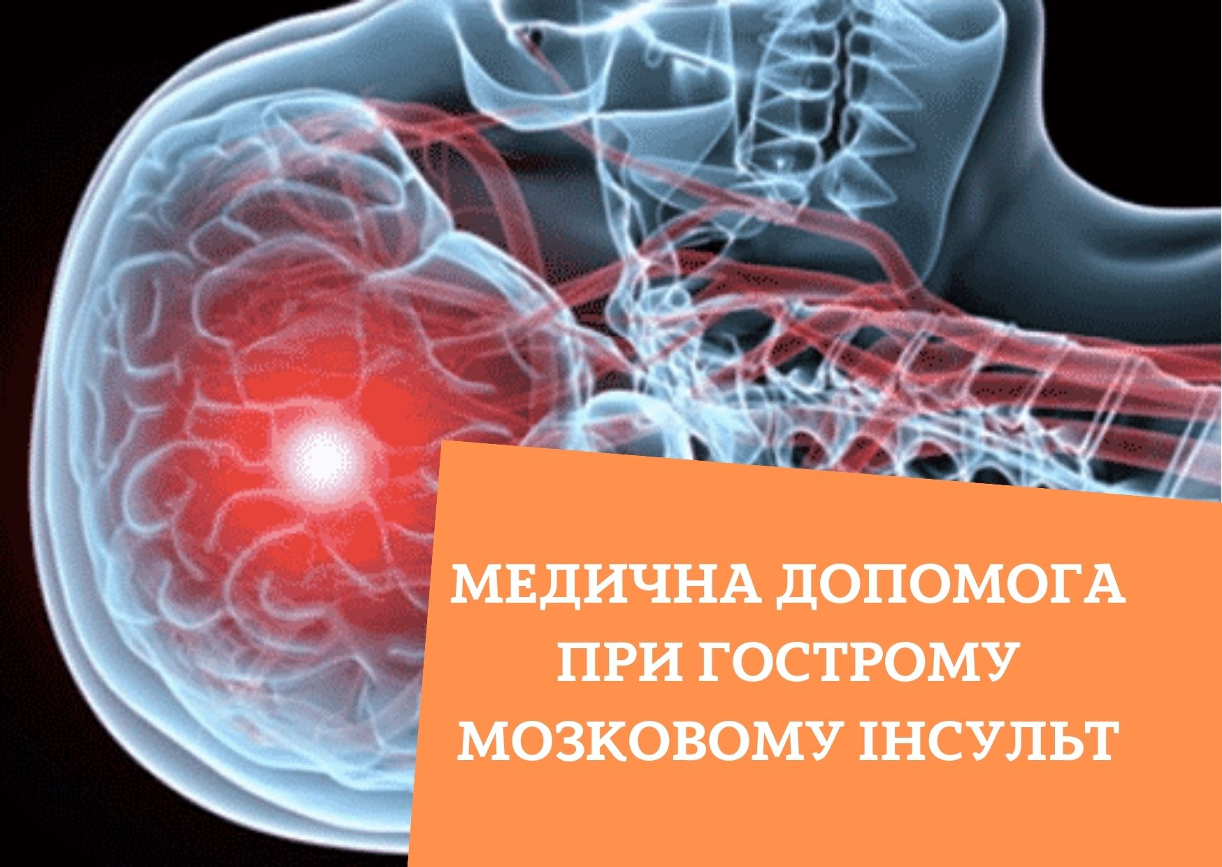 Медична допомога при гострому мозковому інсульт