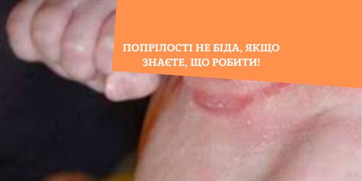 Попрілості не біда, якщо знаєте, що робити!