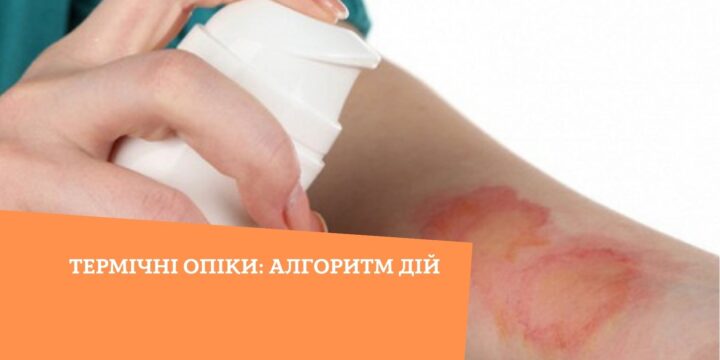 Термічні опіки: алгоритм дій
