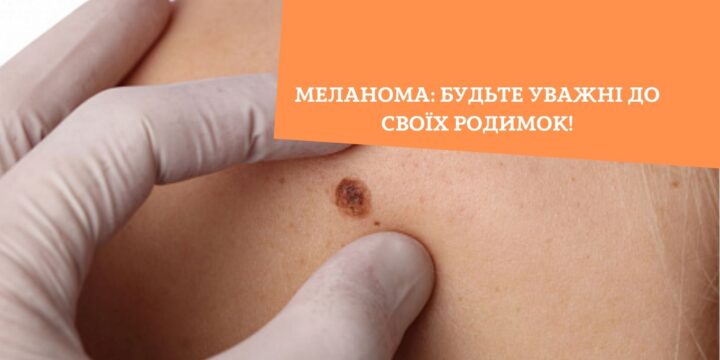 Меланома: будьте уважні до своїх родимок!