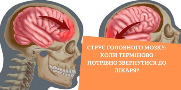 Струс головного мозку: коли терміново потрібно звернутися до лікаря?