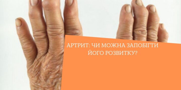 Артрит: чи можна запобігти його розвитку?