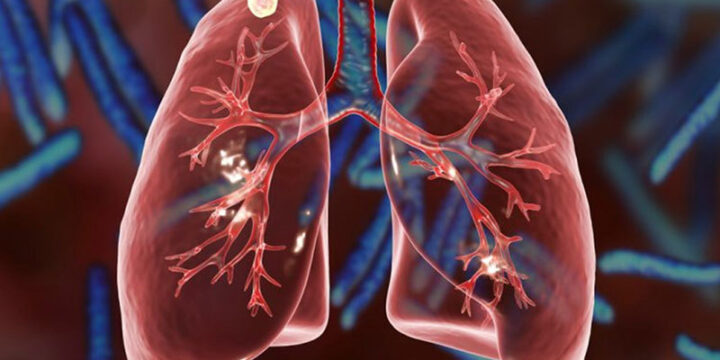 Туберкульоз: як вчасно розпізнати симптоми?