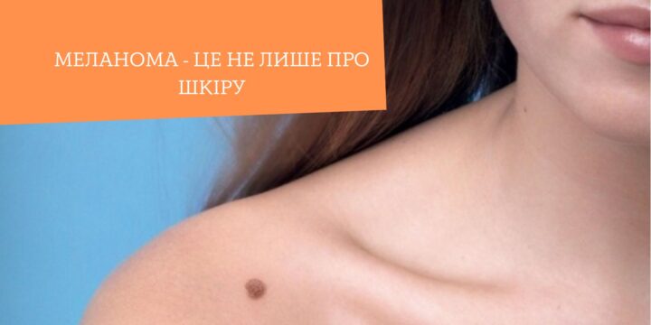 Меланома – це не лише про шкіру