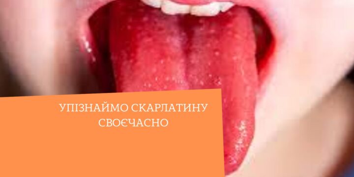 Упізнаймо скарлатину своєчасно