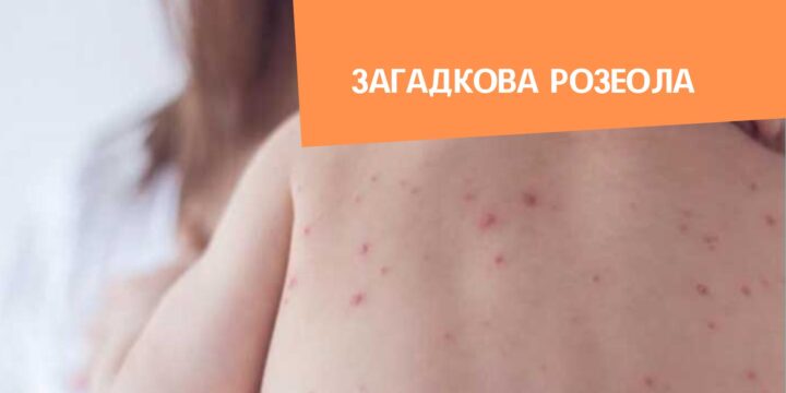 Загадкова розеола