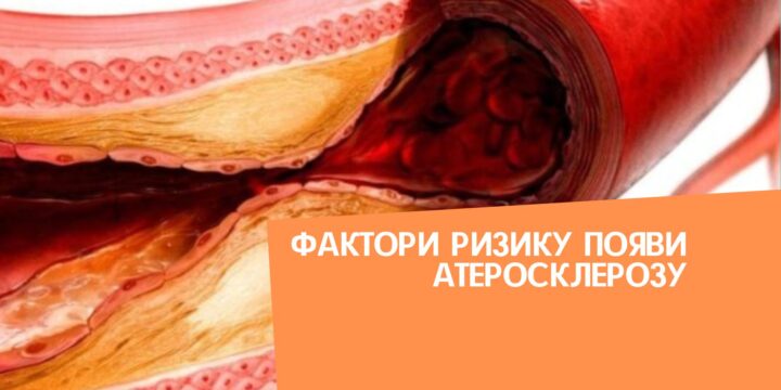 Фактори ризику появи атеросклерозу
