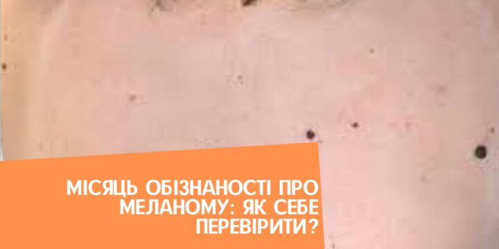 Місяць обізнаності про меланому: як себе перевірити?