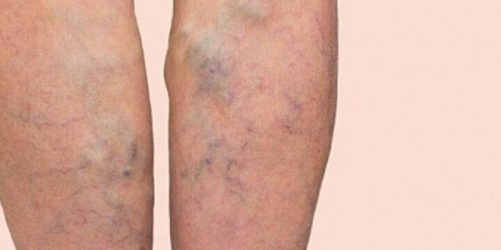 Чи виникне варикоз вен через перехрещення ніг під час сидіння?