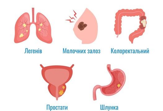 Найпоширеніші види раку в Україні