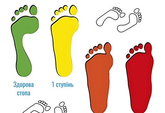 Ступені плоскостопості